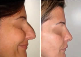 prima_dopo_chirurgia_estetica2